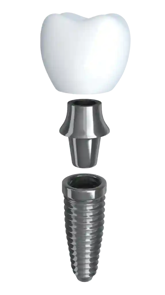 Dental Implant